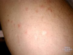Stings on Arm